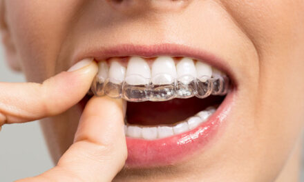 What Are The Most Important Facts Of Transparent Teeth Braces?