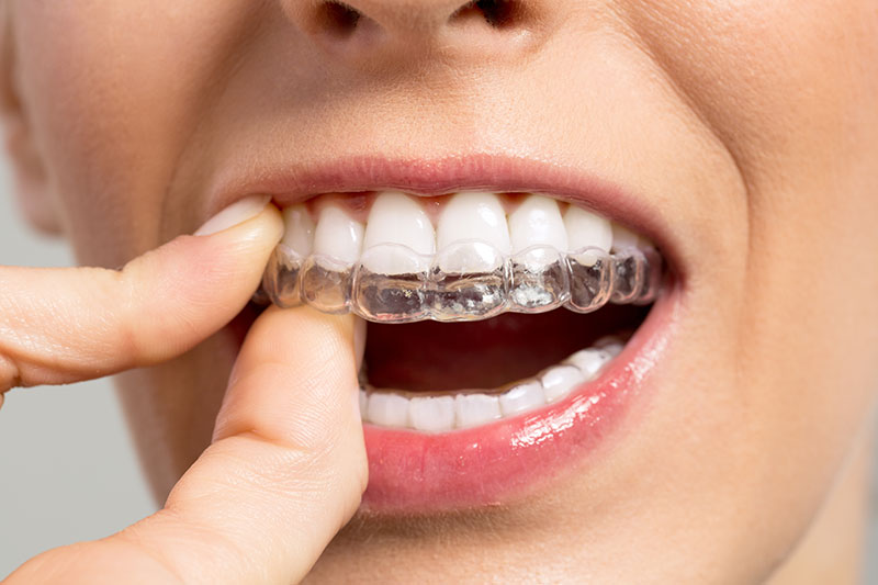 What Are The Most Important Facts Of Transparent Teeth Braces?