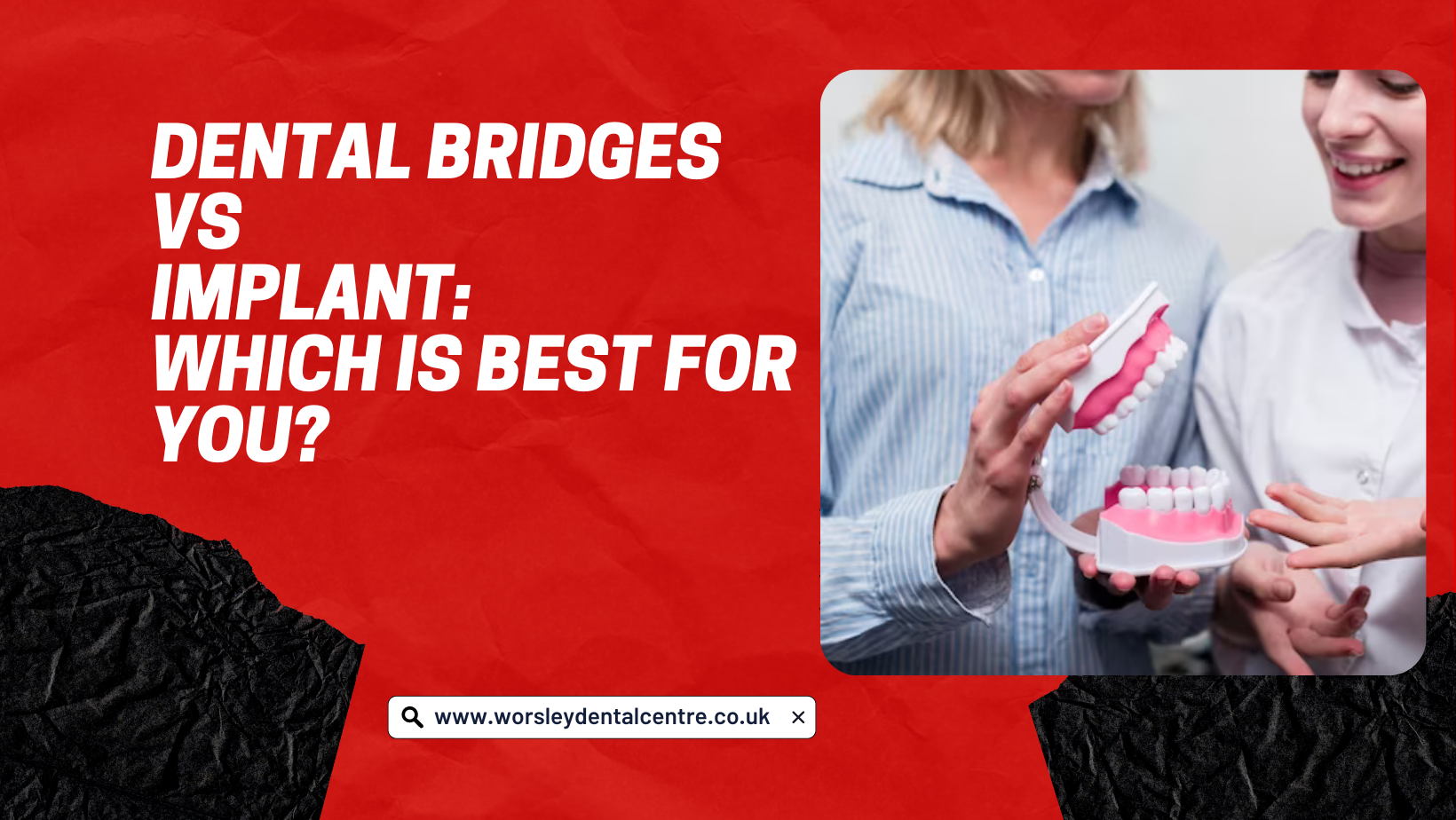 Dental Bridges Vs Implant: Which Is Best For You